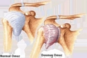 Donuk Omuz Sendromu Belirtileri ve Tedavisi Donuk Omuz Sendromu Belirtileri ve Tedavisi