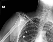 Omuz Çıkığı Belirtileri ve Tedavisi Omuz Çıkığı Belirtileri ve Tedavisi